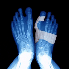 Corrector de juanetes en uso